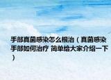 手部真菌感染怎么根治（真菌感染手部如何治疗 简单给大家介绍一下）