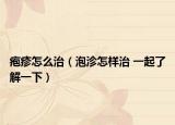 疱疹怎么治（泡沴怎样治 一起了解一下）