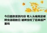 今日最新更新内容 老人头痛竟是被蜱虫连吸数日 被蜱虫咬了后果很严重吗