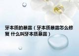 牙本质的暴露（牙本质暴露怎么修复 什么叫牙本质暴露）