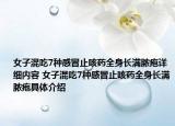 女子混吃7种感冒止咳药全身长满脓疱详细内容 女子混吃7种感冒止咳药全身长满脓疱具体介绍
