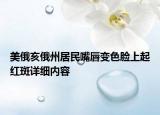 美俄亥俄州居民嘴唇变色脸上起红斑详细内容