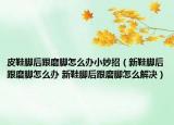 皮鞋脚后跟磨脚怎么办小妙招（新鞋脚后跟磨脚怎么办 新鞋脚后跟磨脚怎么解决）